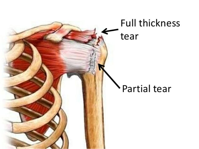 New Technology For Treating Partial Thickness Tendon Tears Andrew   663907 